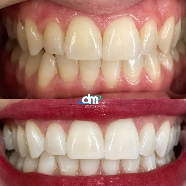 Antes e depois de clareamento dental realizado na DM Smile