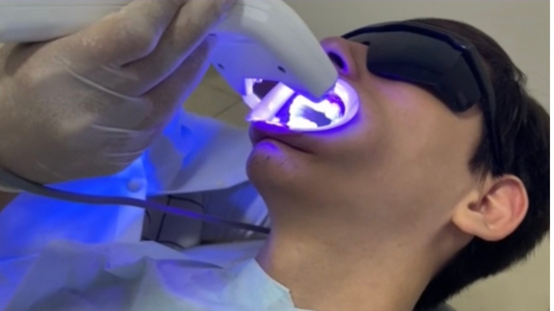 Aplicação do gel clareador com ativação por luz LED no consultório DM Smile